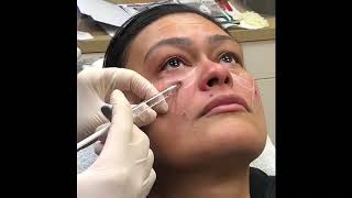 Dermal Filler Eyes and Cheeks