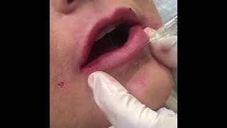 Lip Filler | Philip S. Schoenfeld, M.D.