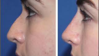 Non Surgical Rhinoplasty