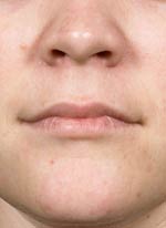 Acne Treatment in Washington DC, before and after Acne Treatment in Washington DC, photo after