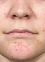 Acne Treatment in Washington DC, photo before