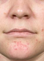 Acne Treatment in Washington DC, before and after Acne Treatment in Washington DC, photo before