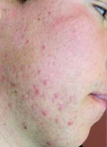 Acne Treatment in Washington DC, before and after Acne Treatment in Washington DC, photo after