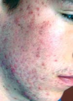 Acne Treatment in Washington DC, before and after Acne Treatment in Washington DC, photo before
