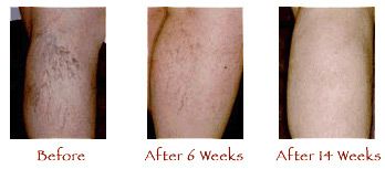 Sclerotherapy in Washington DC