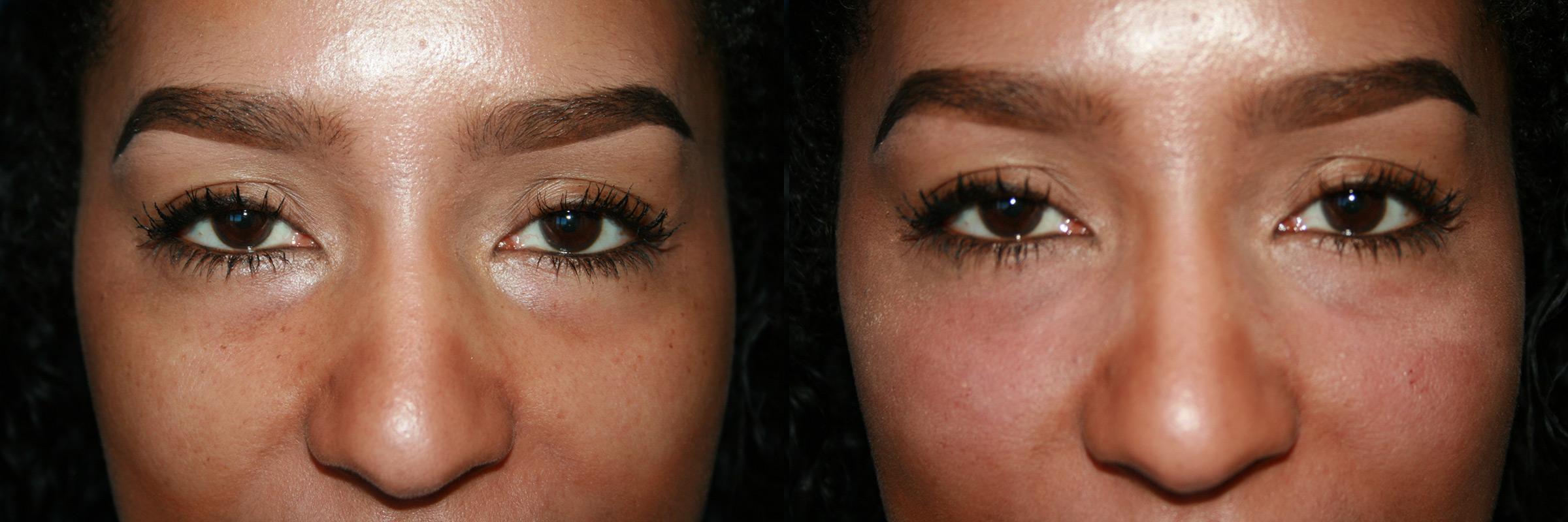 Dermal Filler Pictures Chevy Chase, MD Patient 8402 Dermal Filler Pictures Chevy Chase, MD Patient 8402