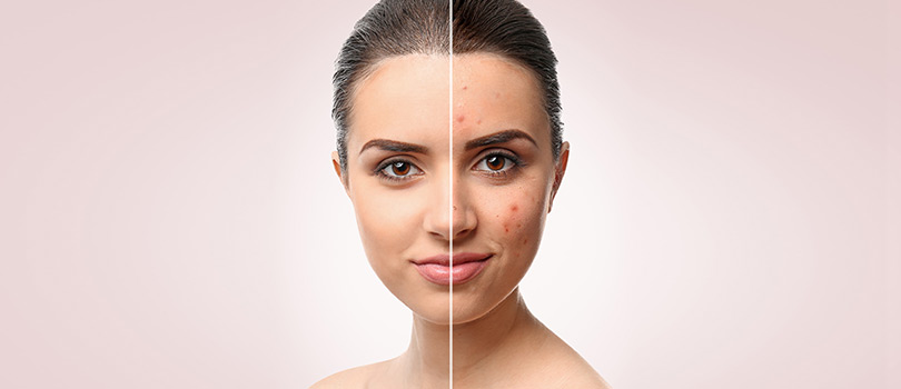 Chemical Peel | Washington DC