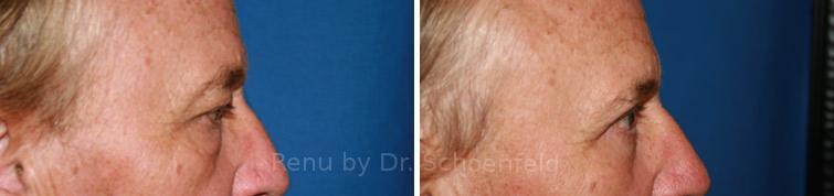 Blepharoplasty Before and After Photos in DC, Patient 7215