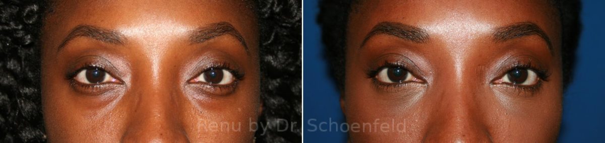 Blepharoplasty Before and After Photos in DC, Patient 8246