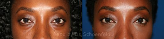 Blepharoplasty Before and After Photos in DC, Patient 8246