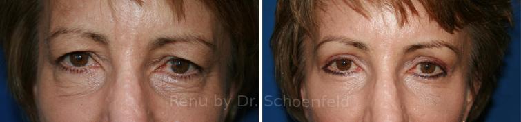 Blepharoplasty Before and After Photos in DC, Patient 7229