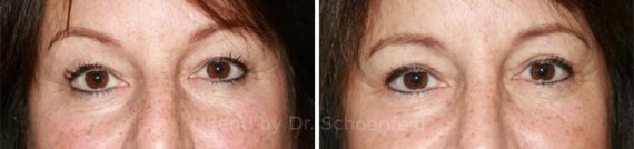 Blepharoplasty Before and After Photos in DC, Patient 7220