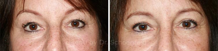 Blepharoplasty Before and After Photos in DC, Patient 7220