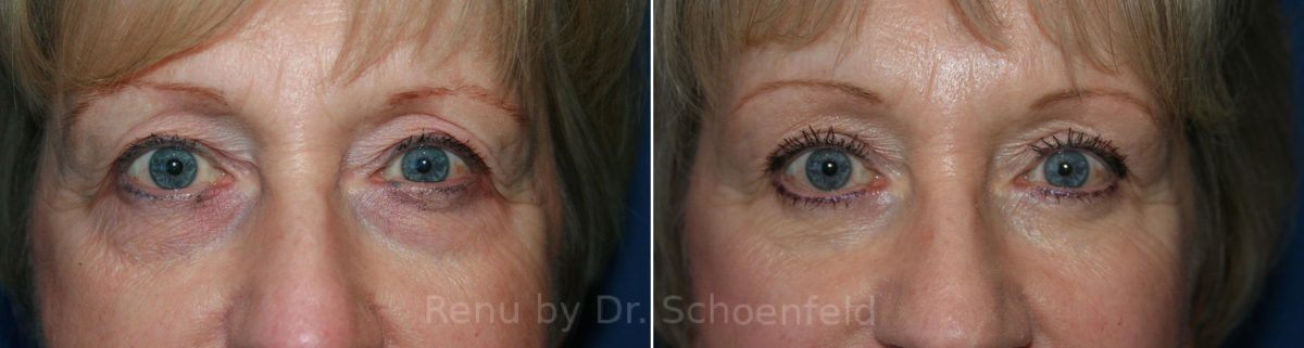 Blepharoplasty Before and After Photos in DC, Patient 7305