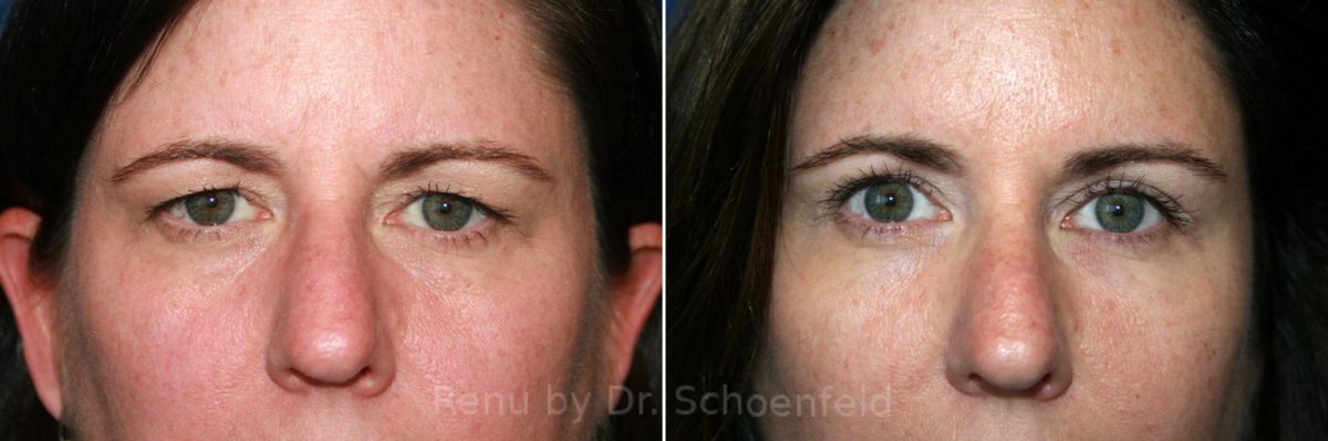 Blepharoplasty Before and After Photos in DC, Patient 7308