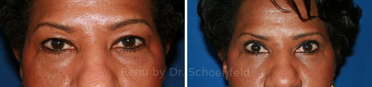 Blepharoplasty Before and After Photos in DC, Patient 7300