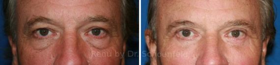 Blepharoplasty Before and After Photos in DC, Patient 7215