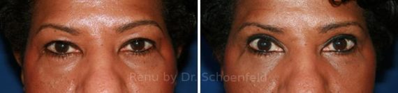 Blepharoplasty Before and After Photos in DC, Patient 7300