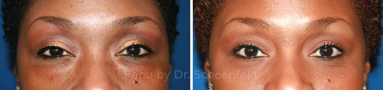 Blepharoplasty Before and After Photos in DC, Patient 7223