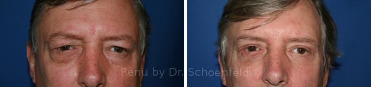Blepharoplasty Before and After Photos in DC, Patient 7226