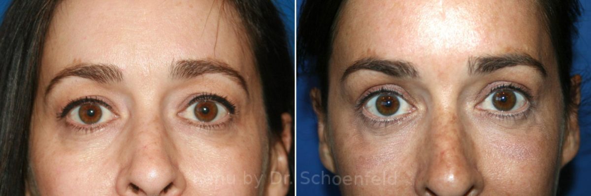 Blepharoplasty Before and After Photos in DC, Patient 7311
