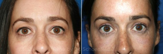 Blepharoplasty Before and After Photos in DC, Patient 7311