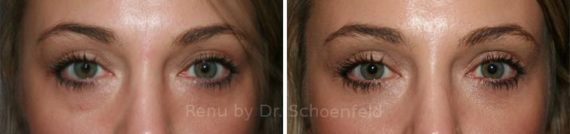 Blepharoplasty Before and After Photos in DC, Patient 7232