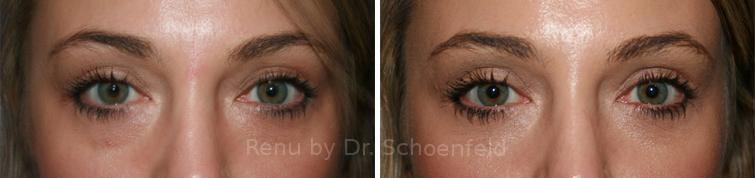 Blepharoplasty Before and After Photos in DC, Patient 7232