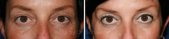 Blepharoplasty Before and After Photos in DC, Patient 7235