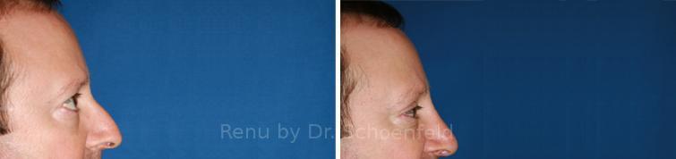 Blepharoplasty Before and After Photos in DC, Patient 7238