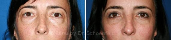 Blepharoplasty Before and After Photos in DC, Patient 7243