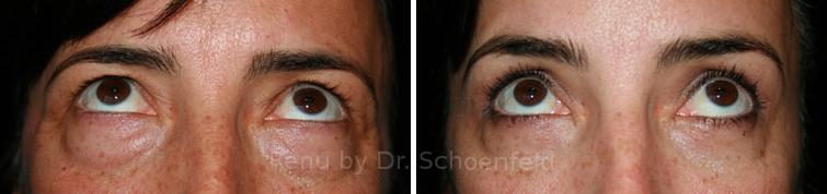 Blepharoplasty Before and After Photos in DC, Patient 7243
