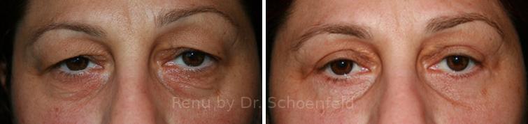 Blepharoplasty Before and After Photos in DC, Patient 7248