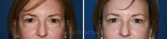 Blepharoplasty Before and After Photos in DC, Patient 7251
