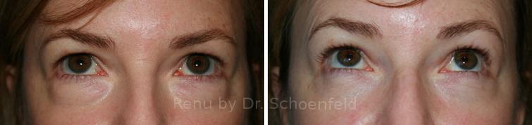 Blepharoplasty Before and After Photos in DC, Patient 7251