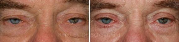 Blepharoplasty Before and After Photos in DC, Patient 7256