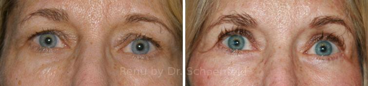 Blepharoplasty Before and After Photos in DC, Patient 7259