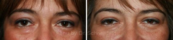 Blepharoplasty Before and After Photos in DC, Patient 7262