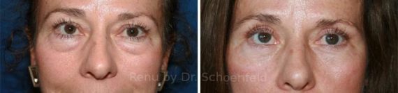 Blepharoplasty Before and After Photos in Chevy Chase, MD