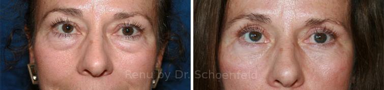 Blepharoplasty Before and After Photos in DC, Patient 7265