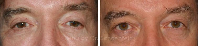 Blepharoplasty Before and After Photos in DC, Patient 7279