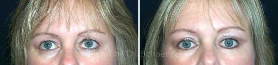 Blepharoplasty Before and After Photos in DC, Patient 7282