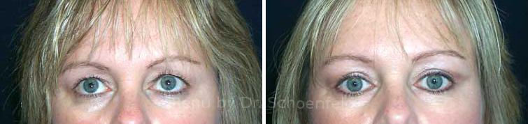 Blepharoplasty Before and After Photos in DC, Patient 7282