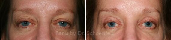 Blepharoplasty Before and After Photos in DC, Patient 7285