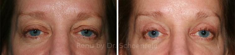 Blepharoplasty Before and After Photos in DC, Patient 7285