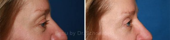 Blepharoplasty Before and After Photos in DC, Patient 7285