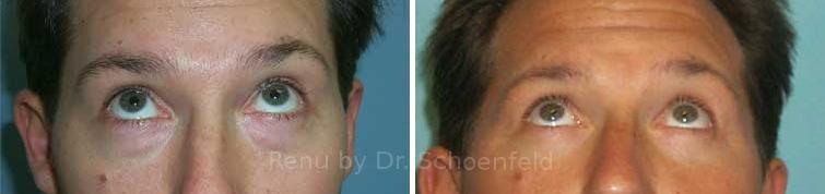 Blepharoplasty Before and After Photos in DC, Patient 7295