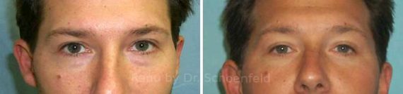 Blepharoplasty Before and After Photos in DC, Patient 7295