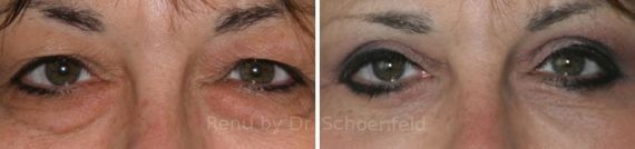 Blepharoplasty Before and After Photos in DC, Patient 7270