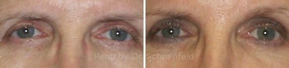 Blepharoplasty Before and After Photos in DC, Patient 7273